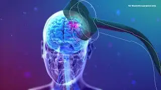 3D animation of TMS (4K High-quality) &mdash; Brain Neurostimulation Visualization