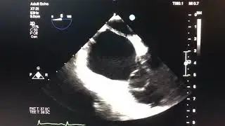 Live 3D Narrow-sector acquisition for an RA Mass