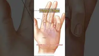 What is trigger finger, cause and treatment #triggerfinger #trendingshorts #doctor #orthopedic