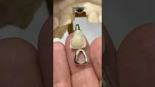 Cementing a Gold Facing #lsk121shorts #dental #teeth