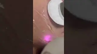 Soprano ice laser hair removal(facial tip)