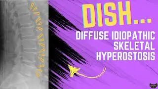 DISH: Diffuse Idiopathic Skeletal Hyperostosis