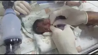 Neonatal  Digital intubation  Flow curve confirmation