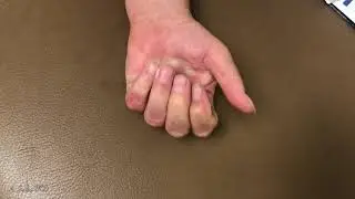 Severe Revision Dupuytren's Contracture Release Results Post Op