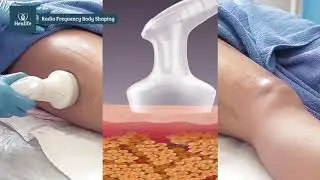 Radio Frequency Body  Contouring at Healife