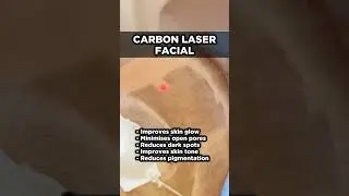 Carbon laser in Delhi | Laser for pigmentation treatment in Delhi | Laser for glowing skin