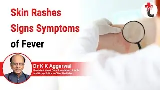 Skin Rashes Signs Symptoms of Fever || Mnemonic Fever And Rash || Fever Rash by Dr KK Aggarwal