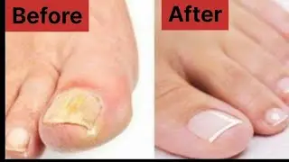 How to prevent and treat nail fungus