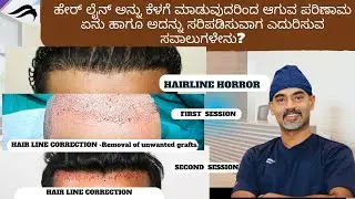 Hair Transplant In Bangalore | Best Surgeon Center & Results Of Hair Transplant In Bangalore