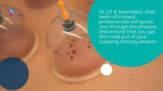Cupping Therapy in Cypress, TX - How It Can Help Your Immune System