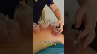 Alleviate Insomnia via Wet Cupping(it works)