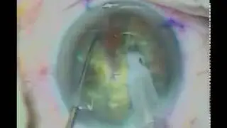 IOL placement in the Coleslaw Shredded Capsular bag