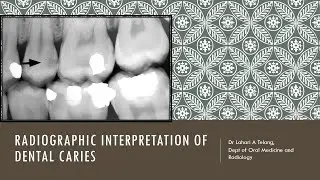 Radiographic interpretation of Dental caries