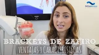 Brackets Zafiro, ventajas y características