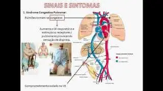 INSUFICIÊNCIA CARDÍACA - AULA 04 - EXAME FÍSICO E MANIFESTAÇÕES CLÍNICAS