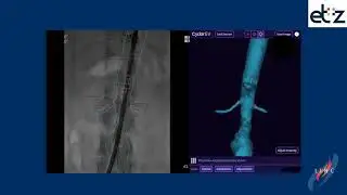 Improve endovascular performance: Comparing Cydar EV with Vessel Navigator from Philips.