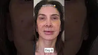 INSANE 2-Week Facelift Healing and Recovery Process!