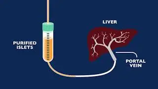 Auto Islet Transplant Program