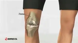 Breg OA Unloader Knee Braces For Osteoarthritis