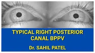 Typical Right Posterior Canal BPPV
