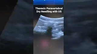 Dry needling to thoracic paravertebral muscles with US guidance