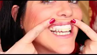 New Teeth (Crown Lengthening Surgery) Part 2