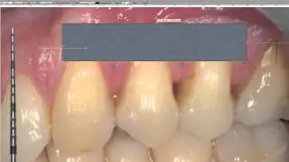 How to Plan a Mucogengival Surgery ?