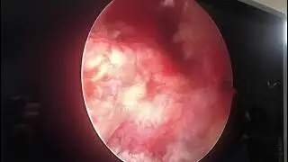 Complete PCL tear kabbadi player great video #acl #acltear #pcl #pcltear #india #chandigarh