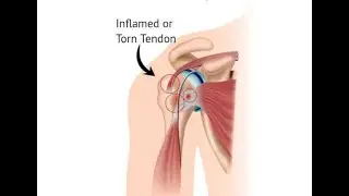 Tenodesis, Tenolysis, Tendon realignment; orthopedic or hand surgery procedures involving tendons