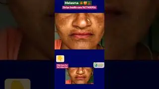 Melasma 🍁🍑🍒 #shorts #viral #trending #health #naturopathy #melasma #healthcare #tamil