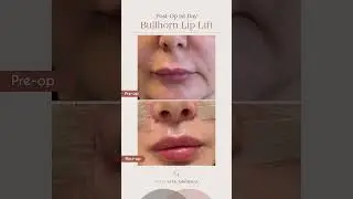 Ever wondered how your scar will look just one day after a bullhorn lip lift?
