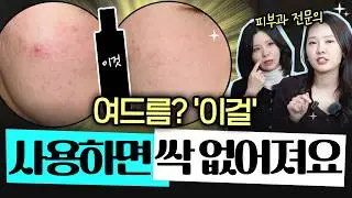 집에서 '이걸' 사용하면 여드름 없앨 수 있습니다♥️ 