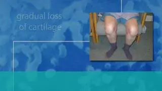 The NIH Osteoarthritis Initiative