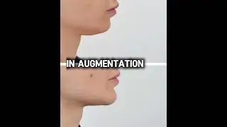 Chin augmentation with Dr.Zhuravsky