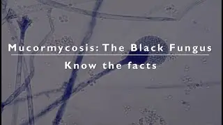 Mucormycosis - The Black Fungus. Know the facts