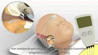 Gehoorscreening bij pasgeboren baby's; derde meting, AABR. (Professionals)