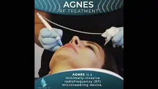 Agnes Treatment At Setiba Medical Spa
