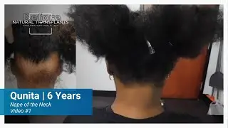 Ponytail Confidence Restored After Nape of Neck Hair Transplant | Dr. Huebner (Qunita)