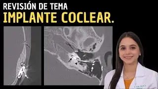 Revisión de Tema 42: Implante coclear.