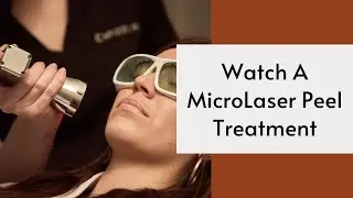 POV MicroLaser Peel #lasertreatment