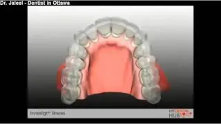 Orthodontics - Invisalign Braces - Ottawa Dentist