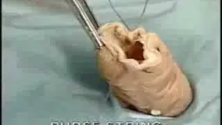 surgery purse string suturing  medicine