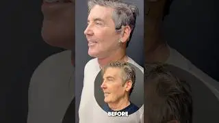 67 Year Old Man's Amazing Face & Neck Lift Result | Before & After  #necklift #turkeyneck #facelift