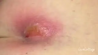 Pilonidal cyst pics