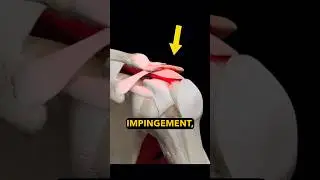 Ущемление плеча? Две вещи, которые вам НУЖНО знать!