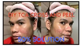 Part 1: DIY TCA CROSS AND PEEL using 50% Solution | Acne Scars/Pimple Marks Remedy/Treatment At Home