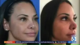 Morpheus8 by InMode | Waiting Room Video | Med Spa Services By Poplar MedSpa