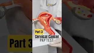 Cervical Cancer #cancer #shortsfeed #doctor #cervicalcancerawareness