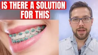 Tooth Neck Wear | Cause and Solution | Dental Abfraction (Dentist Explains)