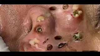 Face Steam and Full Extraction Combo Session